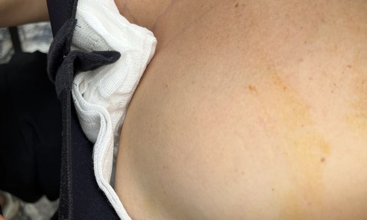 Es posible tener doble burbuja y que se solucione solo? - 82271