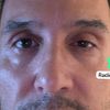 Me coloque Radiesse y dos semanas después comenzó a caerse el párpado