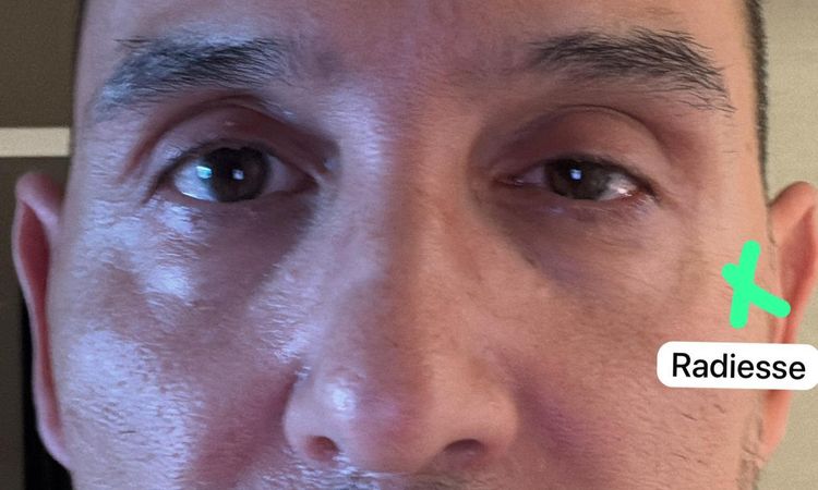 Me coloque Radiesse y dos semanas después comenzó a caerse el párpado - 82297