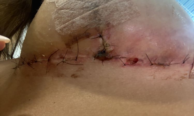 Heridas mastopexia pecho derecho - 82310