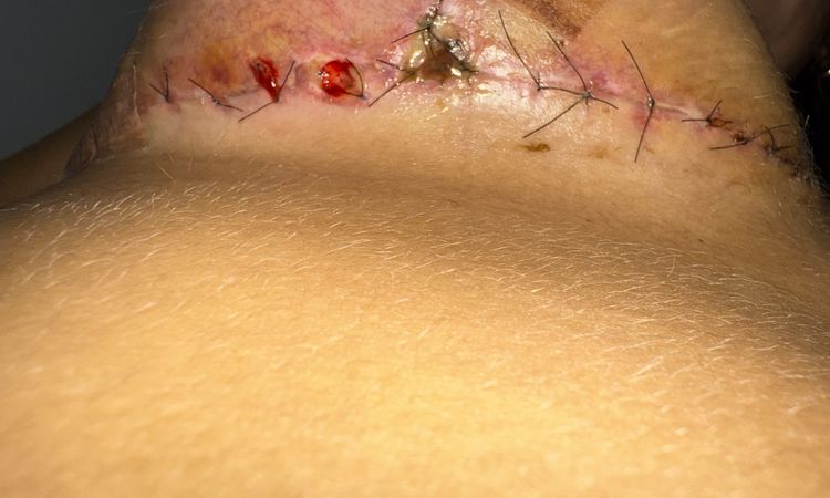 Heridas mastopexia pecho derecho - 82311