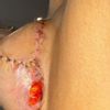 Heridas mastopexia pecho derecho
