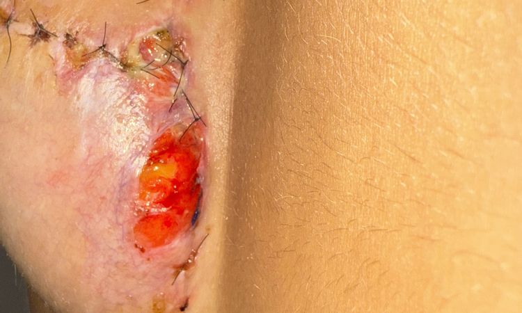 Heridas mastopexia pecho derecho - 82312