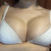 Sinmastia incipiente o evolución natural? 5 meses postoperada