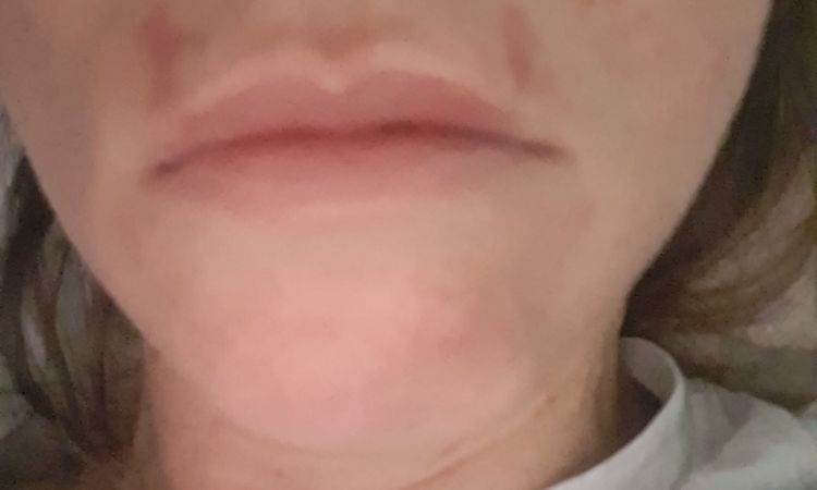 Código de barras con ácido hialurónico - 82484