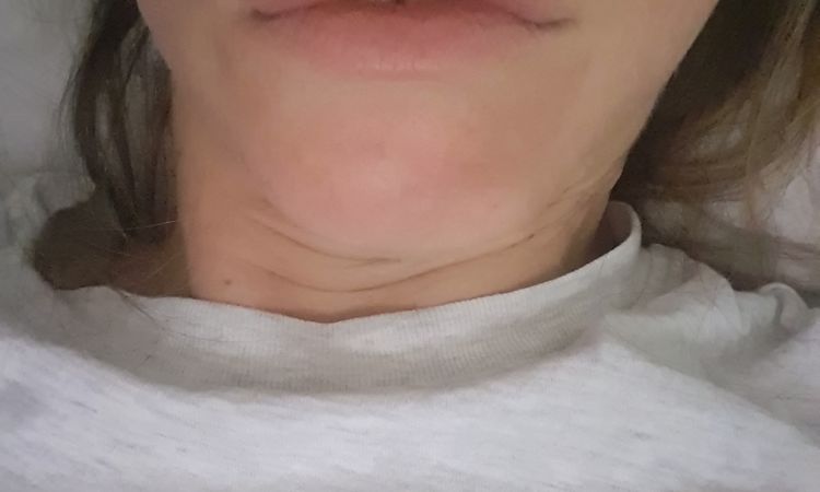 Código de barras con ácido hialurónico - 82485