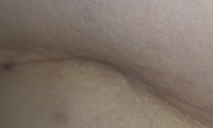 Tengo 1 mes de mastopexia y uno de mis senos quedo raro - 82534