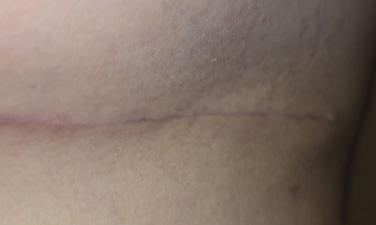 Tengo 1 mes de mastopexia y uno de mis senos quedo raro - 82535
