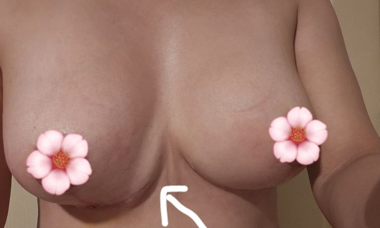 Pliegue de mastopexia - 82571