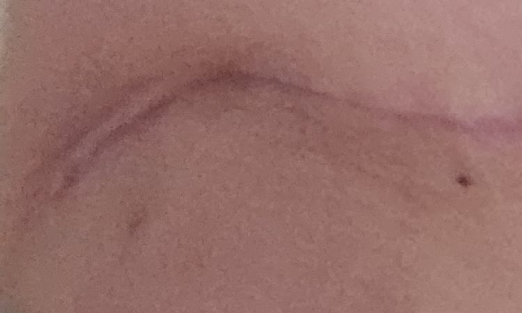 Pliegue de mastopexia - 82573