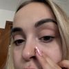 Ojeras moradas tratamiento definitivo