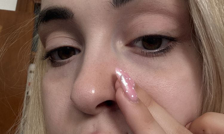 Ojeras moradas tratamiento definitivo - 82616