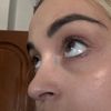 Ojeras moradas tratamiento definitivo
