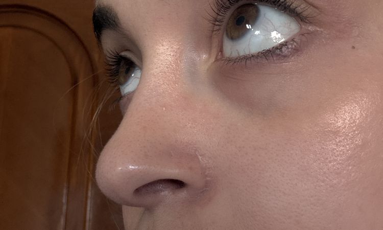 Ojeras moradas tratamiento definitivo - 82617