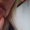 Me hiciero lipofiling ¿se pouede disolver lo migrado?
