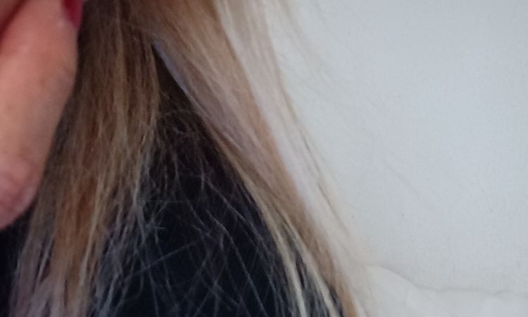 Me hiciero lipofiling ¿se pouede disolver lo migrado? - 82745
