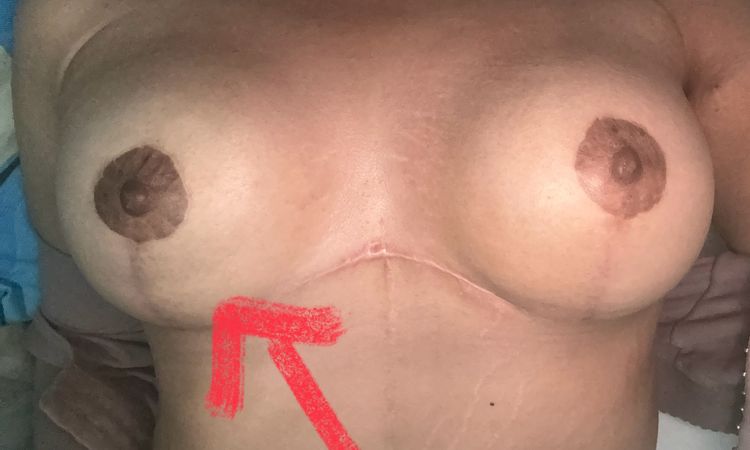 Duda implantes de prótesis de seno - 82746