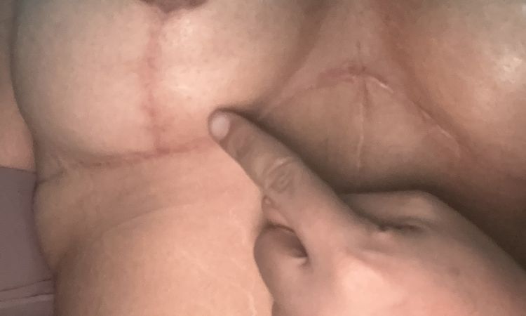 Duda implantes de prótesis de seno - 82748