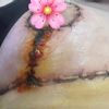 Mastopexia, ¿cicatriz en orden?