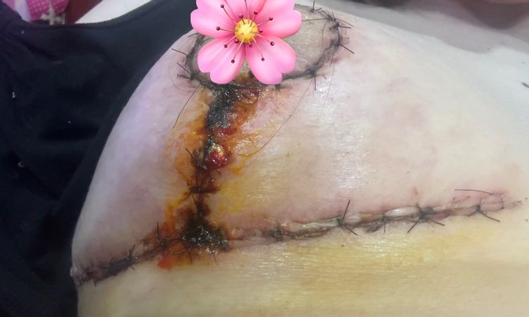 Mastopexia, ¿cicatriz en orden? - 82773