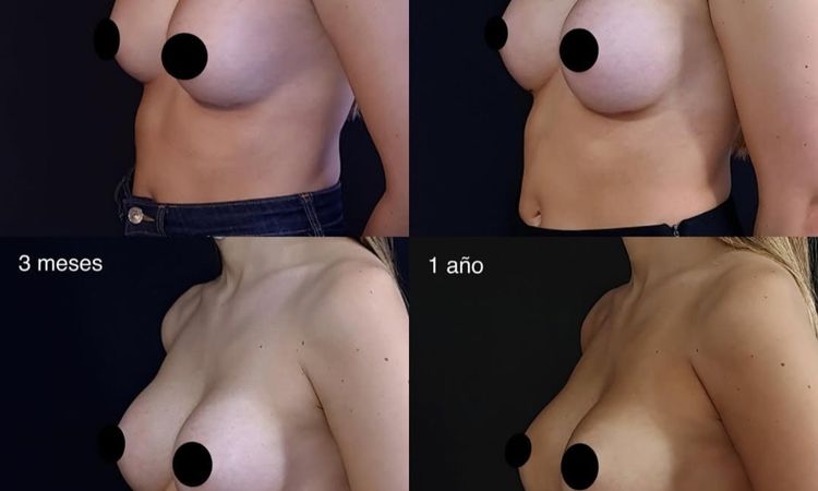 ¿Es así la evolución de las mamas? - 82803