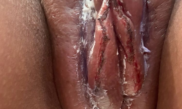 Un día de operada y hay mucha inflamación, labioplastia tipo II - 82810
