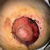Mastopexia areola negra