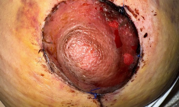 Mastopexia areola negra - 82861