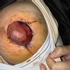 Mastopexia areola negra