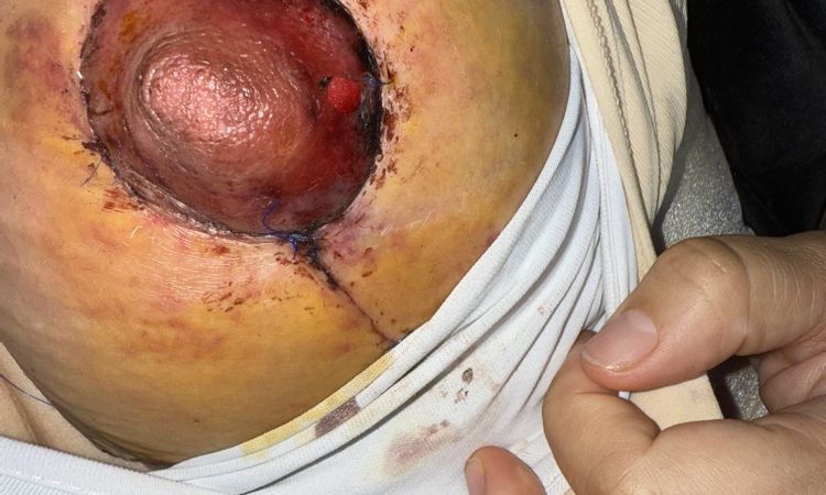 Mastopexia areola negra - 82862