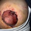Mastopexia areola negra