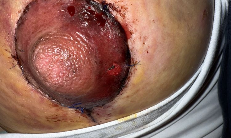 Mastopexia areola negra - 82863