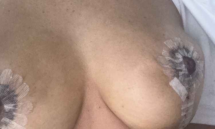 Areolas muy elevadas a 3 días de mí mastopexia - 82932