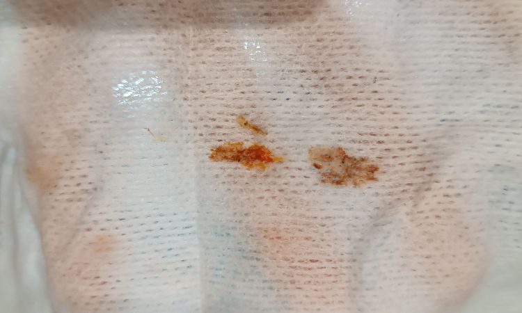 Maxtopexia hace 17 días con dos puntos abiertos - 82935