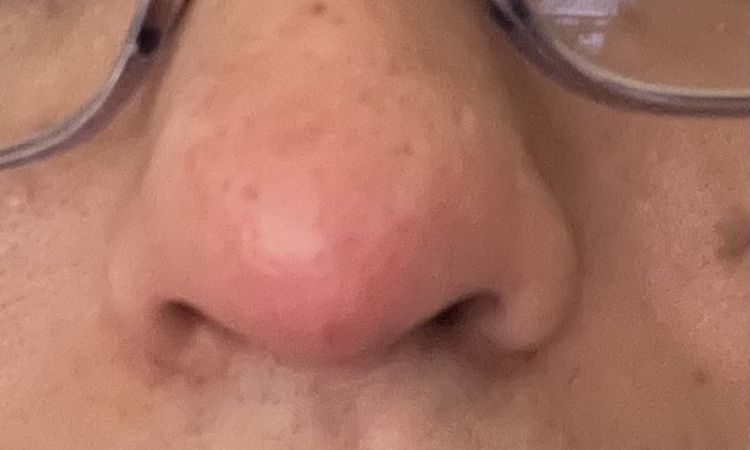 Nariz roja luego de semanas de ponerme ácido hialurónico - 82936