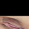 Rejuvenecimiento vaginal