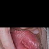 Rejuvenecimiento vaginal