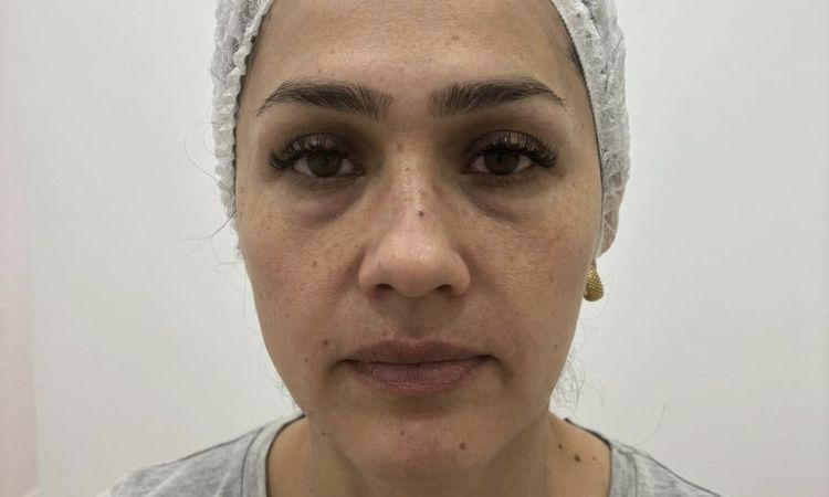 Complicaciones por Ellanse - 83027