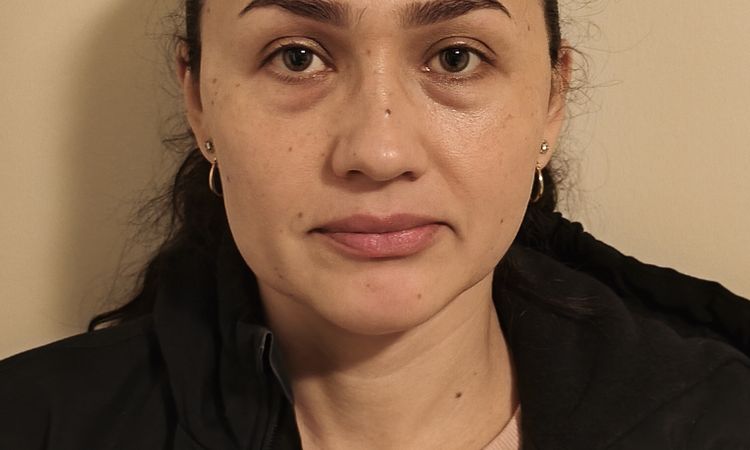 Complicaciones por Ellanse - 83028