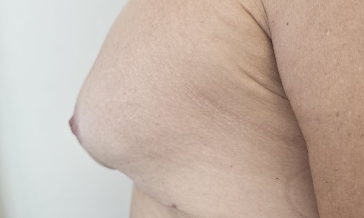 Maxtopesia con cicatriz adherencia - 83061
