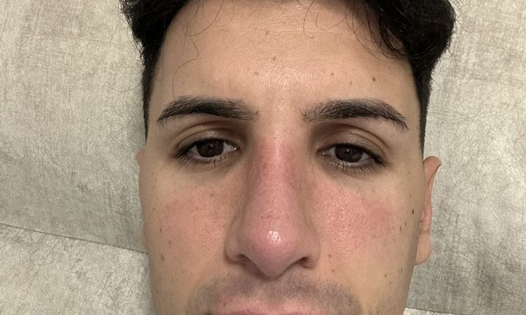 Rojo e inflamado después de rinoplastía - 83123