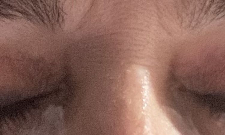 Cirugía de hace dos semanas, la veo muy alta - 83124