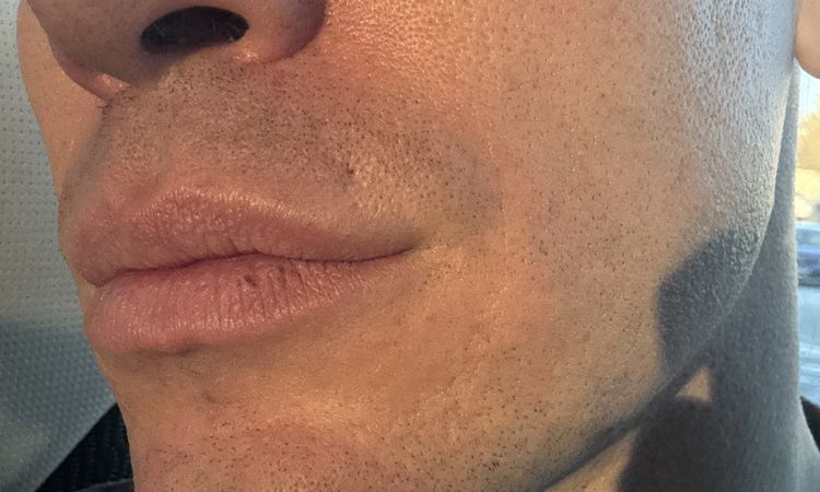 Cicatriz pearcing mala praxis - 83149