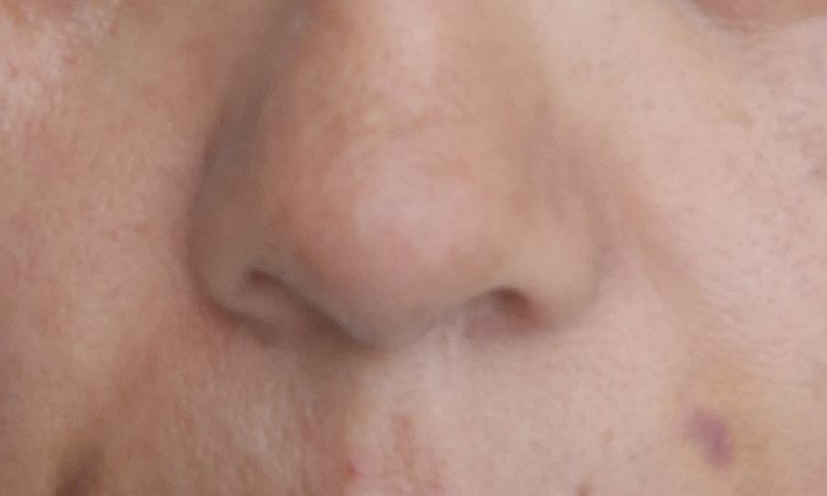 Rinomodelación y relleno de zurco nasogeniano sin resultados - 83155