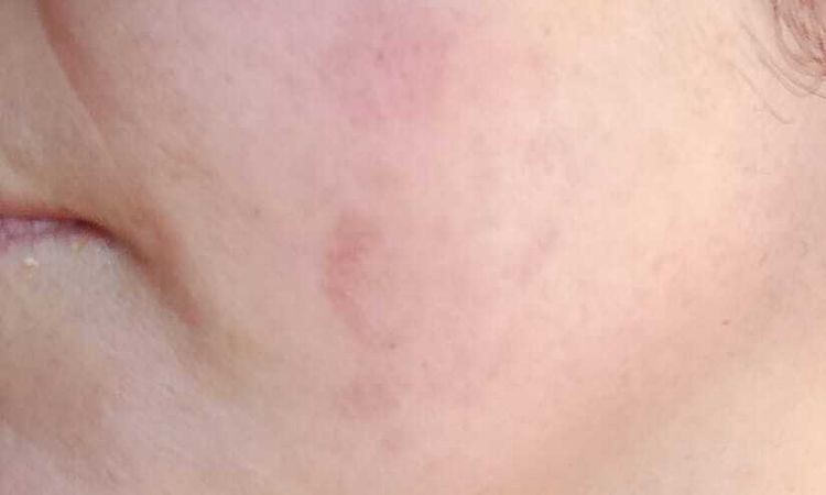 Manchas provocada por fibroblast - 83169