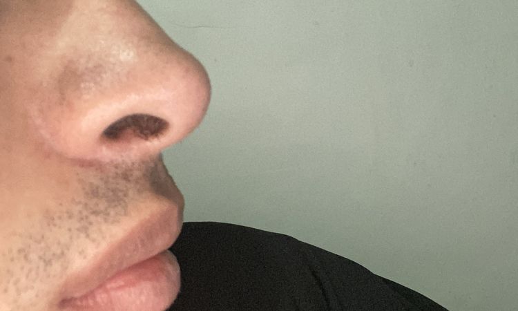 Ácido hialurónico en la nariz - 83172