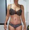 Problemas con ombligo tras abdominoplastia