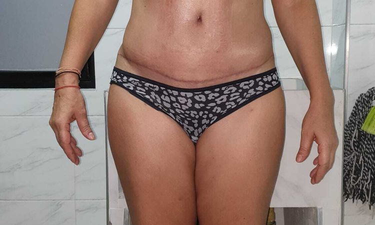 Problemas con ombligo tras abdominoplastia - 83186