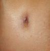 Problemas con ombligo tras abdominoplastia