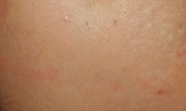 Problemas con ombligo tras abdominoplastia - 83187